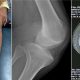 Teknik Bedah Kombinasi Satu Tahap pada Obligatory Patellar Dislocation dan Implikasi Klinis terhadap Stabilitas serta Fungsi Lutut